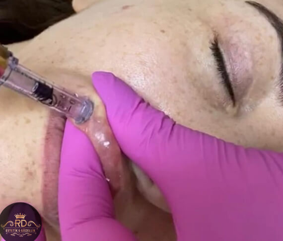 Hyropen İğnesiz Dolgu