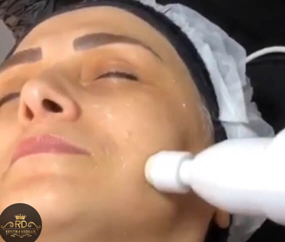 HydraFacial