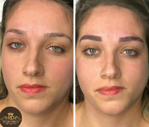 8T Nano Pigmentasyon